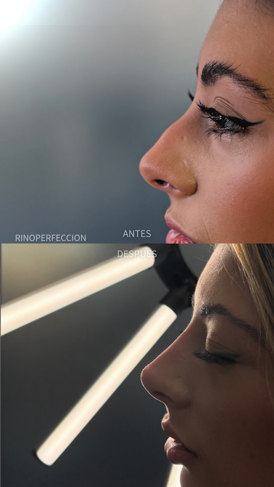 Caso de rinoperfección 4